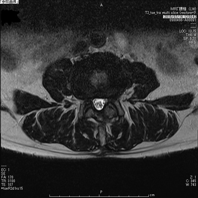腰部脊柱管狭窄症術後MRI水平断