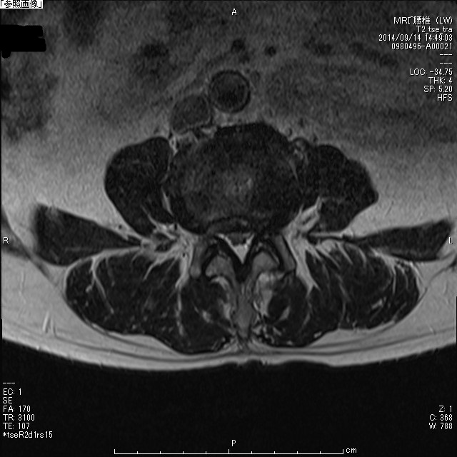 腰部脊柱管狭窄症術前MRI水平断