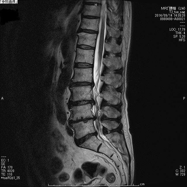 腰部脊柱管狭窄症術前MRI矢状断